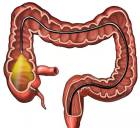 得了十二指腸潰瘍有什麽症狀和感覺？