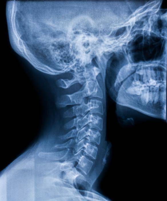x-ray-skull-from-right-side.jpg