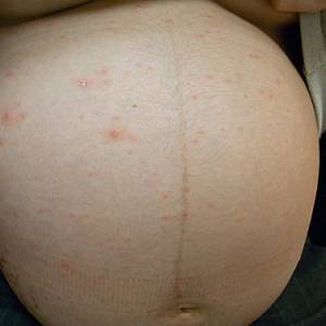 务必防“痘”！ 孕妇感染水痘，对胎儿伤害大！