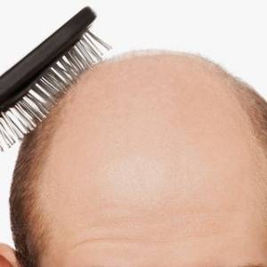 “鬼剃头”能否重长头发？ 有数种方法可治疗！