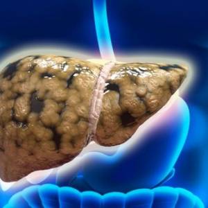 营养过剩小心脂肪肝  肝硬化可能是“吃”出来的！