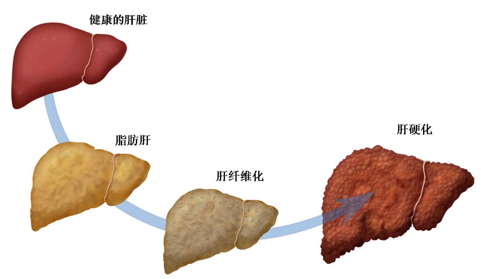 肝病矢量信息图。肝脏疾病的症状和体征。矢量插图。插画图片素材_ID:302899493-Veer图库