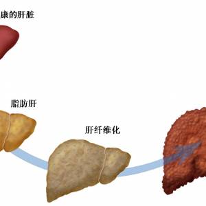 脂肪肝不是肥胖那么简单  它会让你得肝癌！