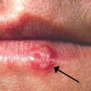 亲个吻或共用唇膏，都有可能中疱疹！