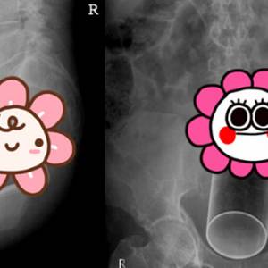 “下体卡异物”案例无奇不有！  医生取出的物品竟包括打蛋器？