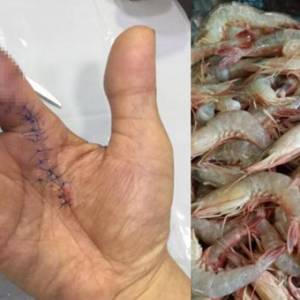 被虾壳刺到遭食肉菌侵噬，男子食指被截掉一小节！