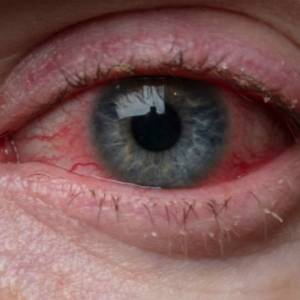 别以为眼睛不舒服滴眼药水就没事！若2个症状出现有可能是“眼癌”！