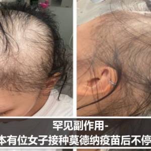 罕见副作用- 日本有位女子接种莫德纳疫苗后不停脱发