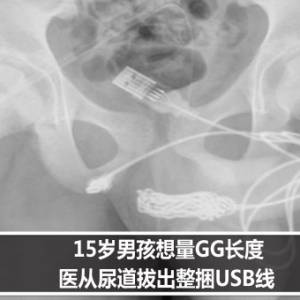 15岁男孩想量GG长度　医从尿道拔出整捆USB线