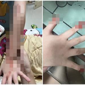 7岁女童染怪病！全身「恐怖渗血」照片曝光　眼睛、手指狂冒血水