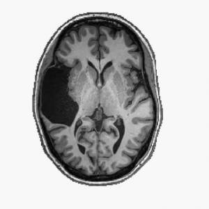 她天生大脑缺一大块，生活却一切正常？！科学家靠她有了惊人发现！