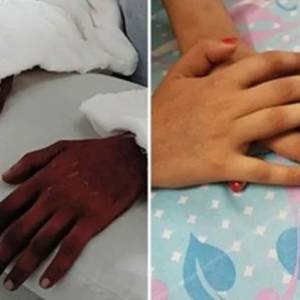 印度女孩双臂移植黑人胳膊，1年后肤色迅速褪淡