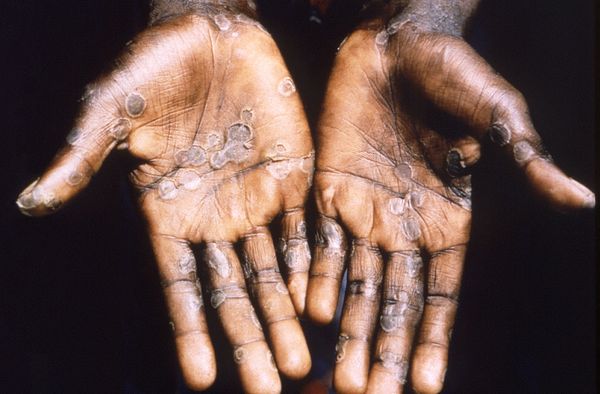 罕见「猴痘」来袭　全球超过100例　症状有哪些、致死率多高？7大QA一次看