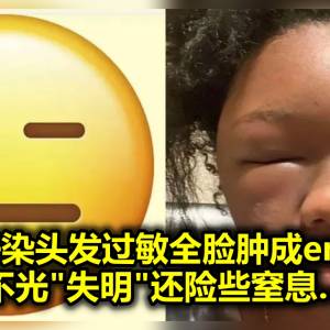 妹子染头发过敏全脸肿成emoji，不光“失明”还险些窒息…