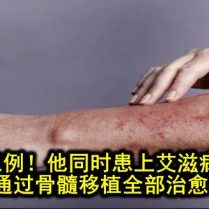 全球第三例！他同时患上艾滋病和血癌，通过骨髓移植全部治愈！