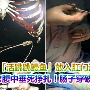 男将「活跳跳鳗鱼」放入肛门治便秘　它腹中垂死挣扎！肠子穿破洞