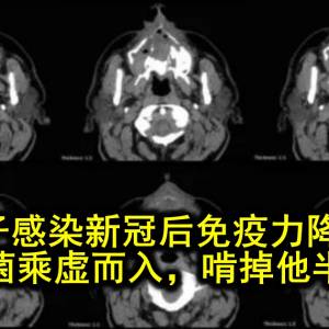 男子感染新冠后免疫力降低，毛霉菌乘虚而入，啃掉他半张脸