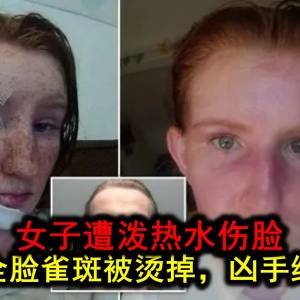 女子在争执中被滚烫热水泼脸，全脸雀斑都被烫掉了?! 凶手判决出炉！