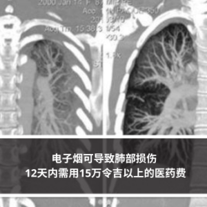 电子烟可导致肺部损伤 12天内需用15万令吉以上的医药费