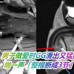 男子做爱时GG滑出又猛撞！　啪一声「整根断成3节」