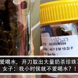 不爱喝水，开刀取出大量奶茶珍珠？！女子：我小时侯就不爱喝水？！