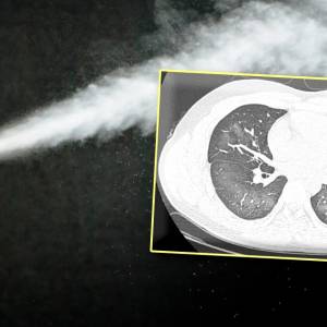 20岁男喷防晒喷雾害肺“大片变白”！　医生示警这个“用法失误”很危险！