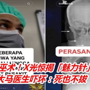 女病患中巫术！X光惊揭「魅力针」插在体内　大马医吓坏：死也不拔