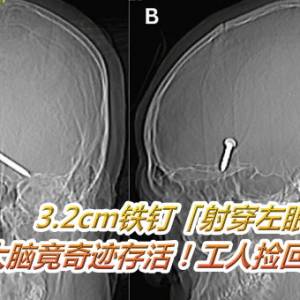 3.2cm铁钉「射穿左眼」卡在大脑竟奇迹存活！工人捡回视力