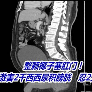 整颗椰子塞肛门！阿伯找刺激害2千西西尿积膀胱　忍2天剖腹取出