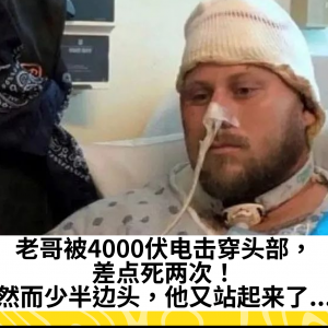 老哥被4000伏电击穿头部，差点死两次！然而少半边头，他又站起来了...