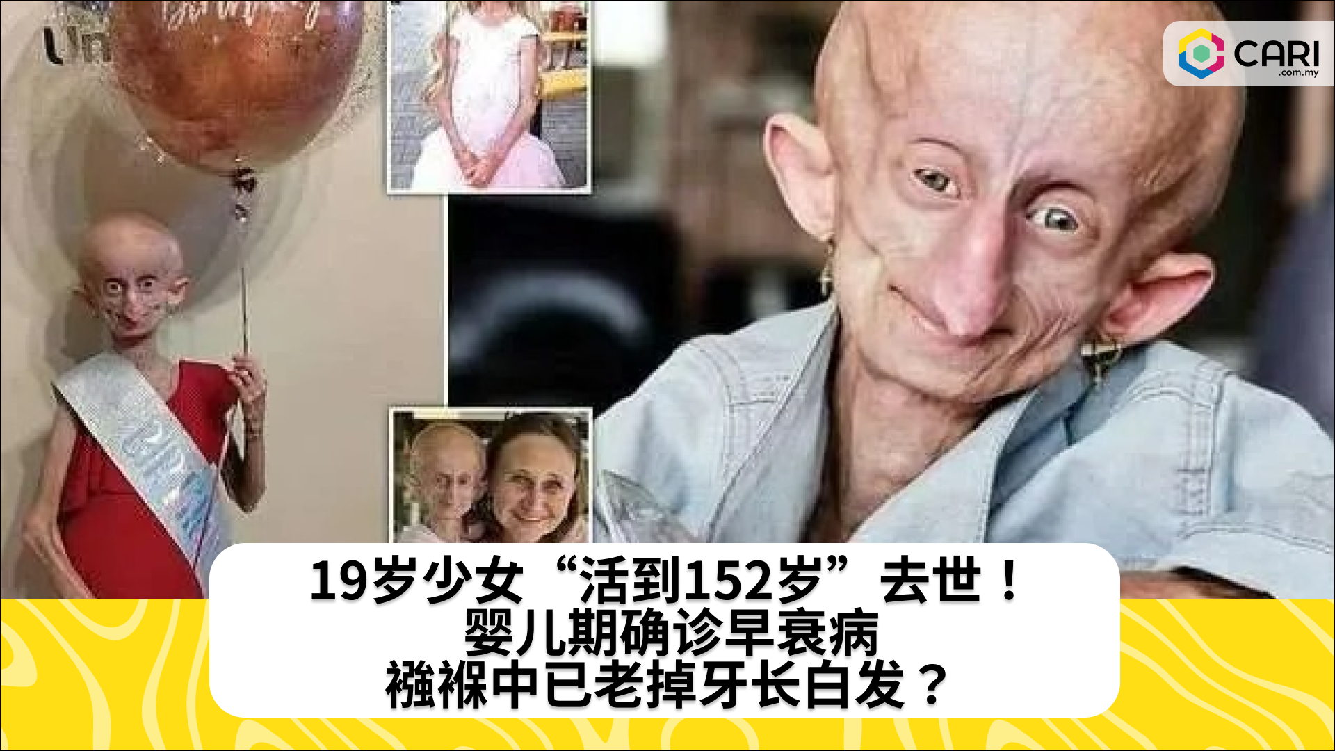 19岁少女“活到152岁”去世！婴儿期确诊早衰病，襁褓中已老掉牙长白发？