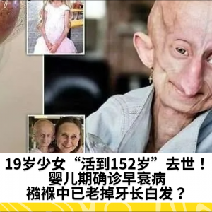 19岁少女“活到152岁”去世！婴儿期确诊早衰病，襁褓中已老掉牙长白发？