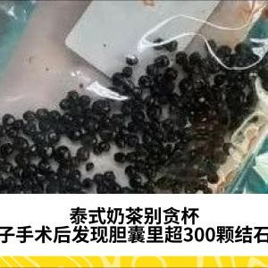 泰式奶茶别贪杯，女子手术后发现胆囊里超300颗结石！