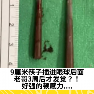 9厘米筷子插进眼球后面，老哥3周后才发觉？！好强的顿感力....