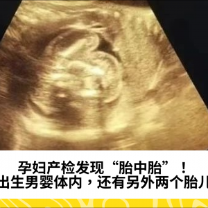 孕妇产检发现“胎中胎”！未出生男婴体内，还有另外两个胎儿…