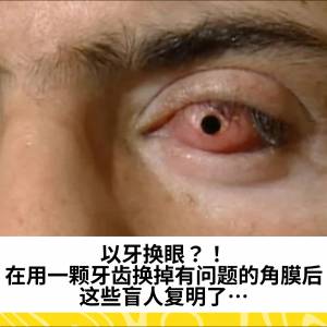 以牙换眼？！在用一颗牙齿换掉有问题的角膜后，这些盲人复明了…