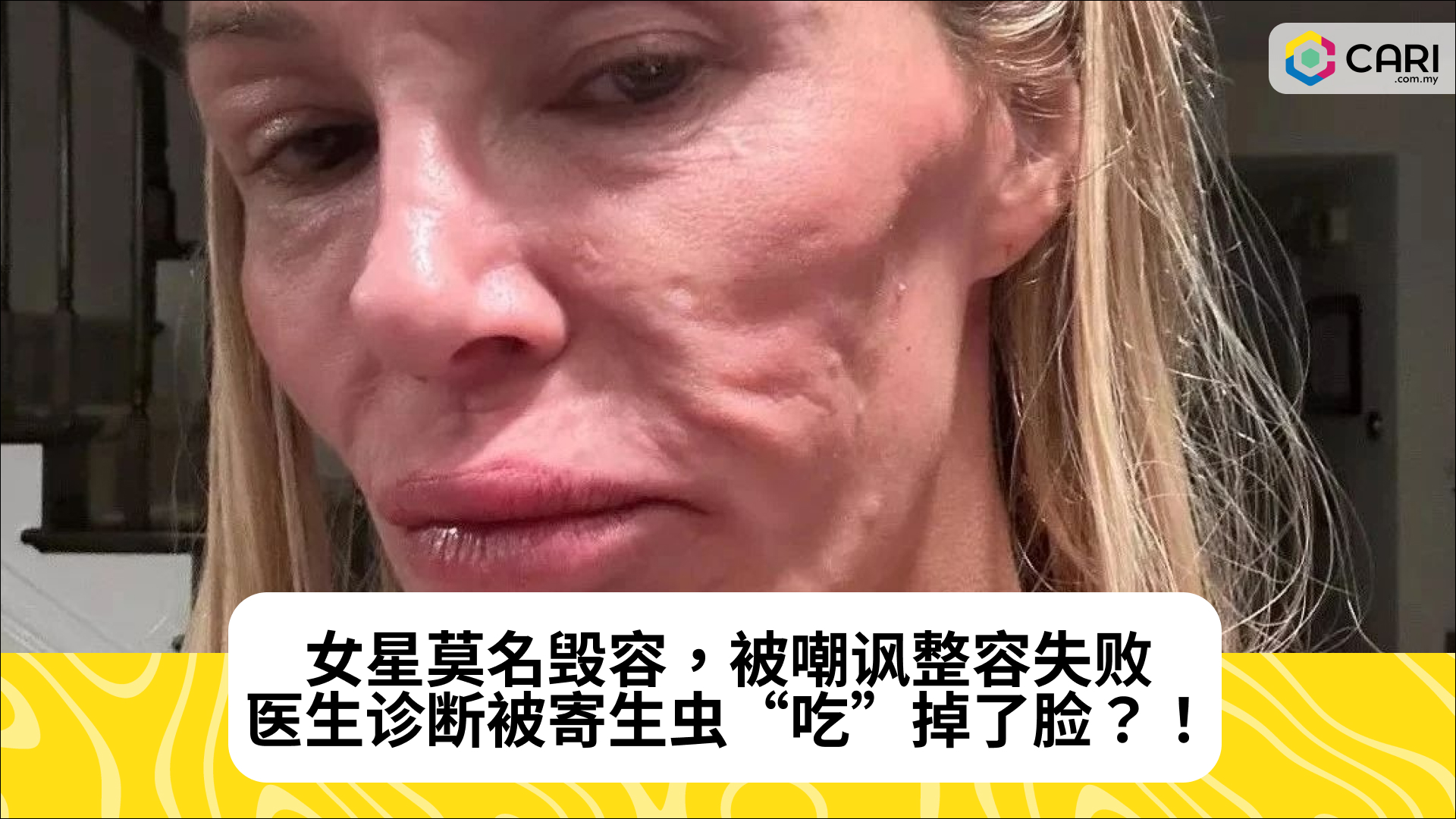 女星莫名毁容，被嘲讽整容失败。医生诊断被寄生虫“吃”掉了脸？！