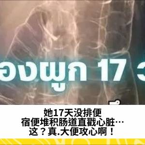 她17天没排便，宿便堆积肠道直戳心脏… 这？真.大便攻心啊！