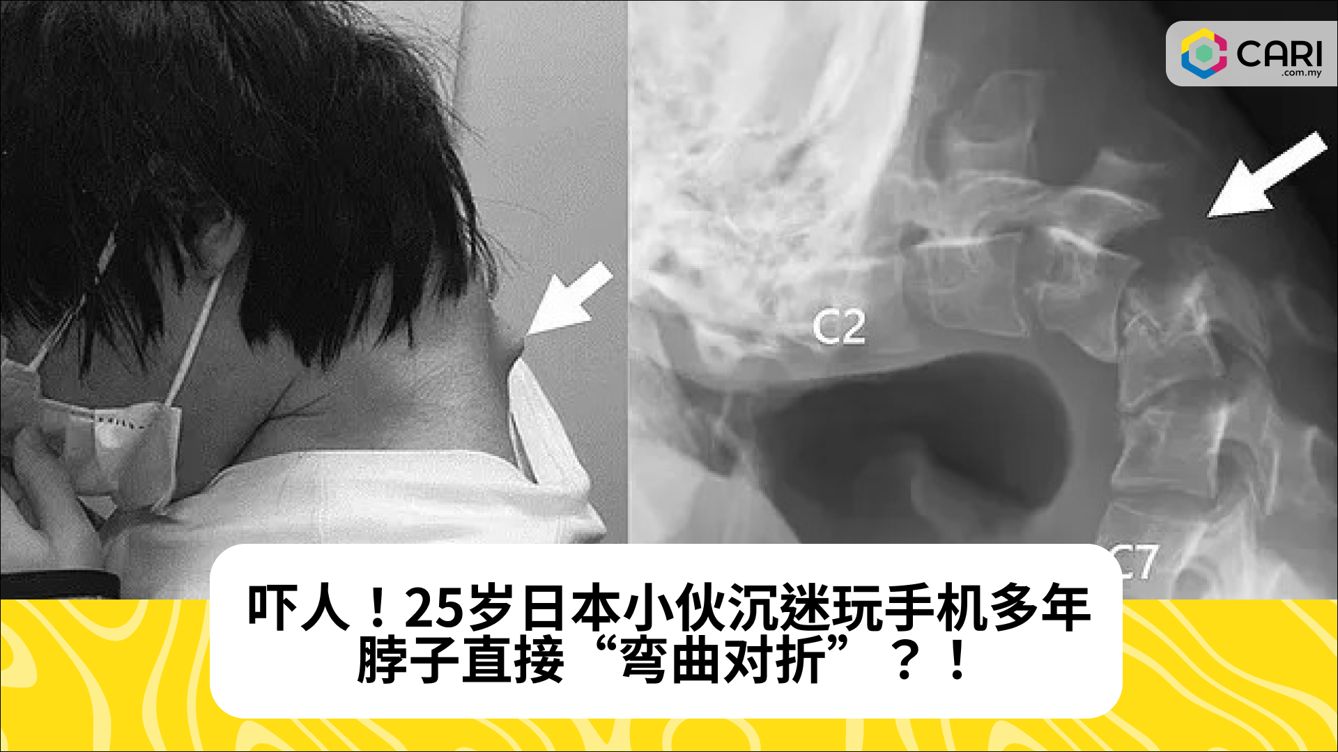 吓人！25岁日本小伙沉迷玩手机多年，脖子直接“弯曲对折”？！