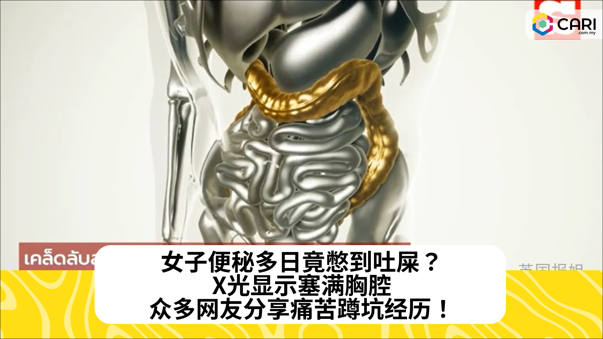 女子便秘多日竟憋到吐屎？X光显示塞满胸腔，众多网友分享痛苦蹲坑经历！