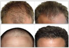 When To Consider Hair Washing after Hair Restoration?
