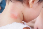 What are the symptoms, causes and treatment of eczema, a common skin condition?