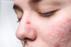 How to scientific facial acne inflammation 3 ways to easily repair acne