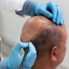 Hair Transplants: A Permanent Solution to Hair Loss