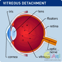 Ubat Mata Glaucoma - Pertanyaan o