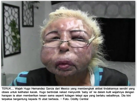 Muka Jadi Hodoh,Gara-gara Suntik Sendiri Baby Oil! - Isu 