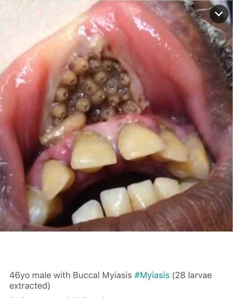 oral-myiasis.jpg