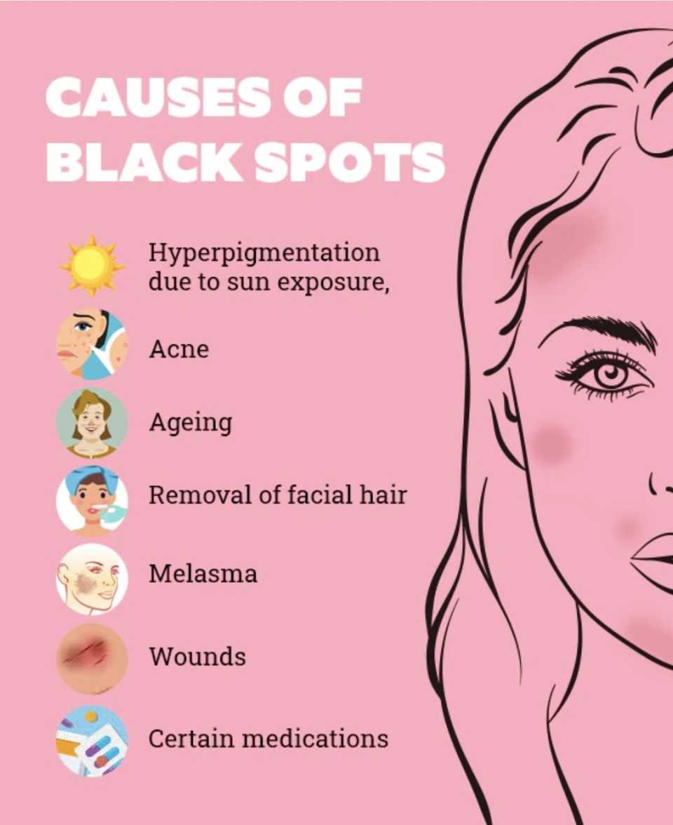 All about Brown Spots, Freckles, Melasma, Pigmentation
