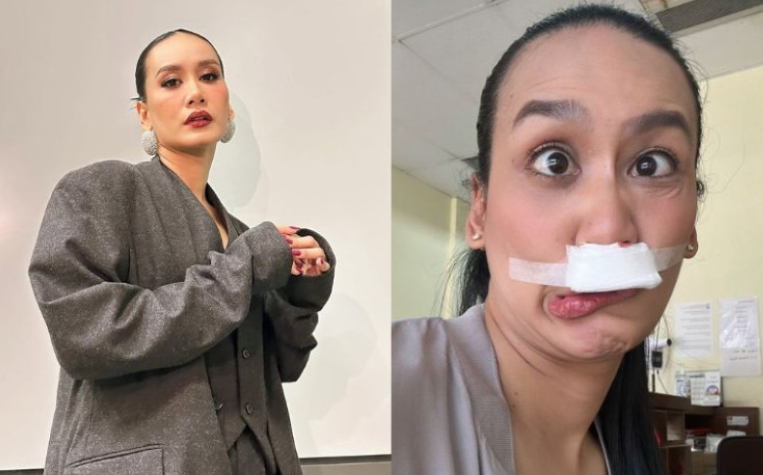 Hidung berdarah, Marsha Milan alami masalah suara