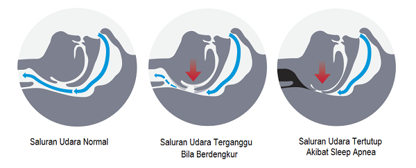 Masalah Tidur Berdengkur.png